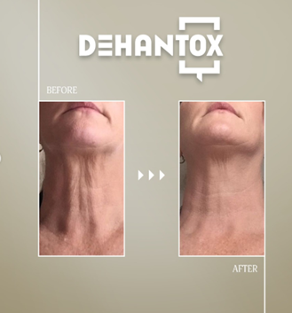 Dehantox Image 2